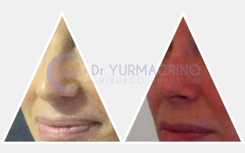 Rhinoplasty – Case 1/B