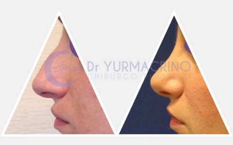 Rhinoplasty – Case 2/A