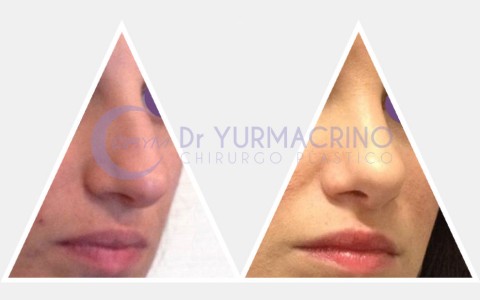 Rhinoplasty – Case 2/B