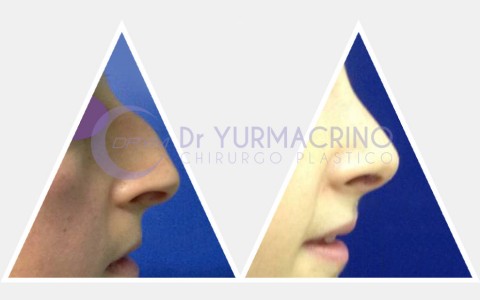 Rhinoplasty – Case 3/A