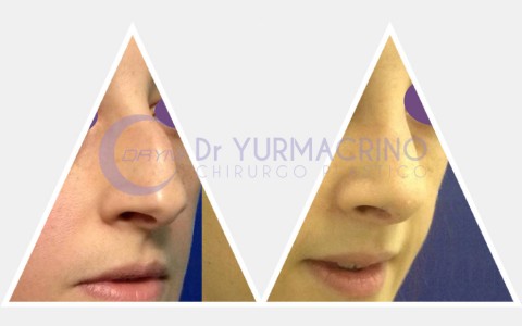 Rhinoplasty – Case 3/B