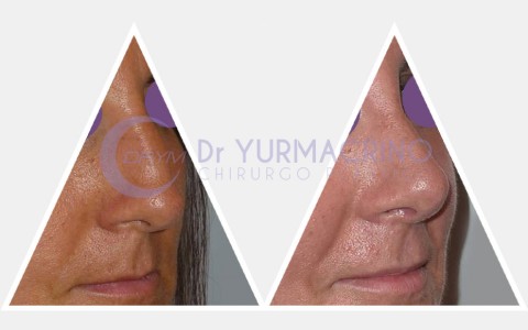 Rhinoplasty – Case 4/A