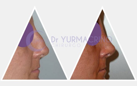 Rhinoplasty – Case 4/B