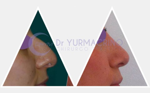 Rhinoplasty – Case 6/A