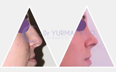 Rhinoplasty – Case 7/A