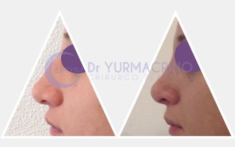 Rhinoplasty – Case 8/A