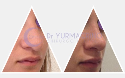 Rhinoplasty – Case 8/B