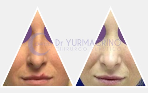 Rhinoplasty – Case 9/A