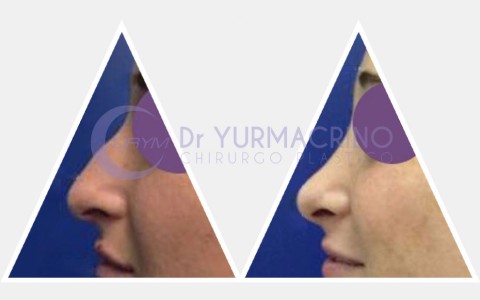 Rhinoplasty – Case 9/B