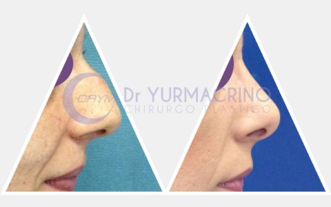 Rhinoplasty – Case 10/A