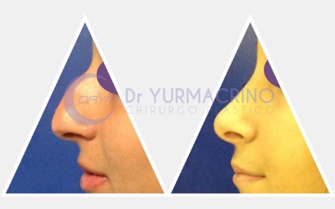 Rhinoplasty – Case 11/A