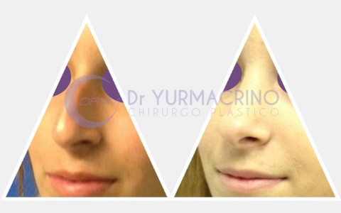 Rhinoplasty – Case 11/B