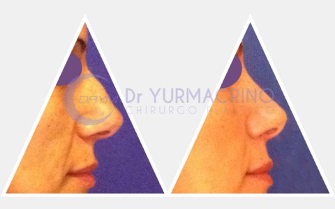 Rhinoplasty – Case 12/A