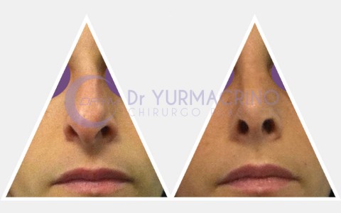 Rhinoplasty – Case 14/B