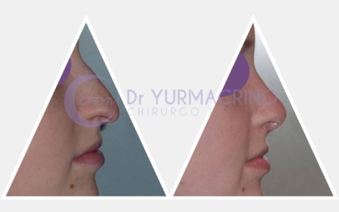 Rhinoplasty – Case 16/A