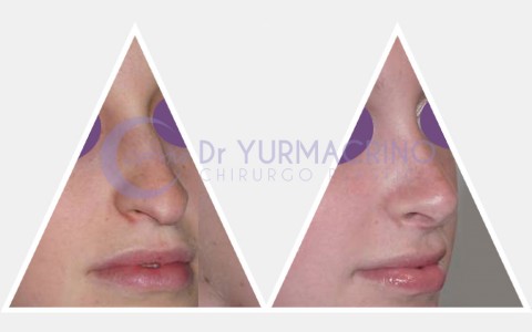 Rhinoplasty – Case 16/B