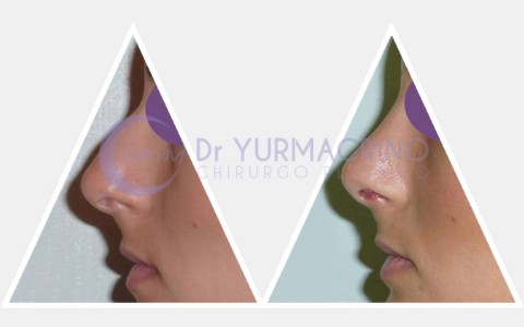 Rhinoplasty – Case 17/A