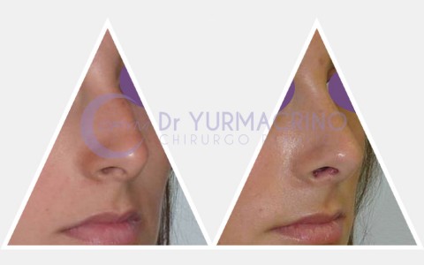 Rhinoplasty – Case 17/B