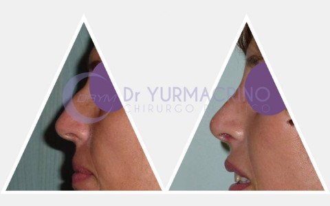 Rhinoplasty – Case 18/B