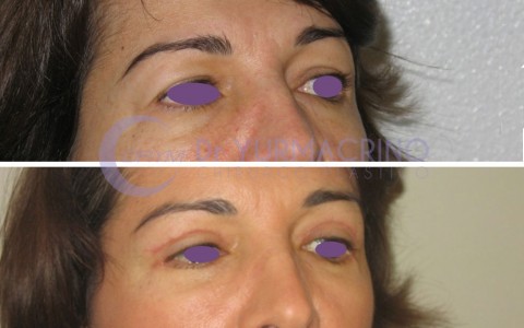 Blepharoplasty – Case 3/A