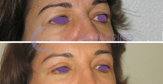 Blepharoplasty – Case 3/A