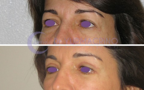 Blepharoplasty – Case 3/B