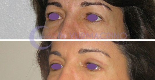 Blepharoplasty – Case 3/B