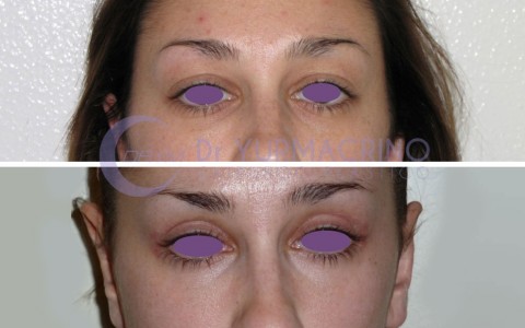 Blepharoplasty – Case 4/A