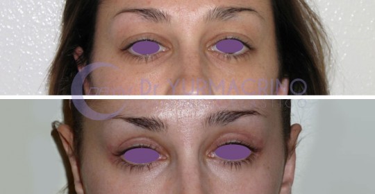 Blepharoplasty – Case 4/A