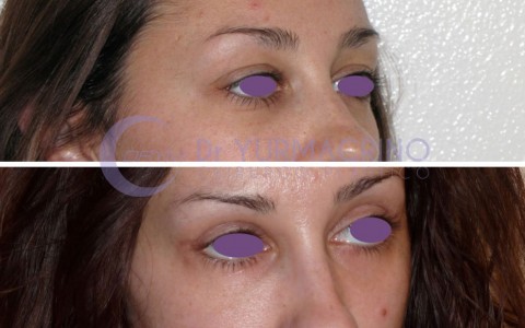 Blepharoplasty – Case 4/B