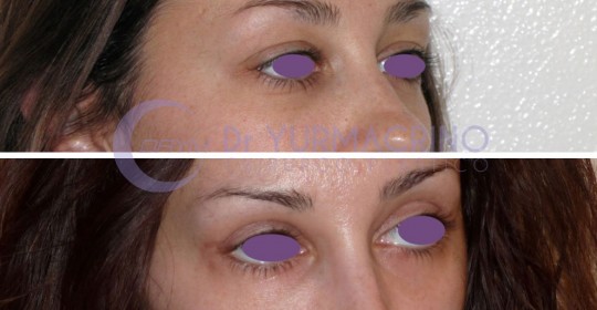 Blepharoplasty – Case 4/B