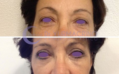 Blepharoplasty – Case 5/A