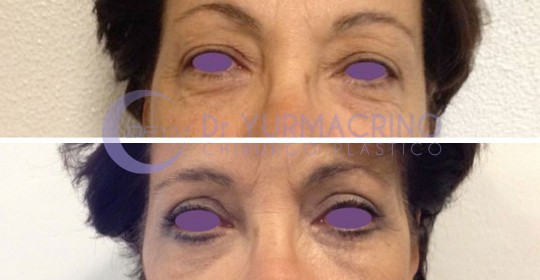 Blepharoplasty – Case 5/A