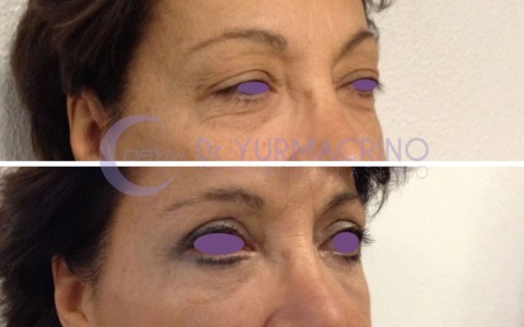 Blepharoplasty – Case 5/B