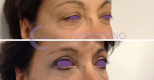 Blepharoplasty – Case 5/B