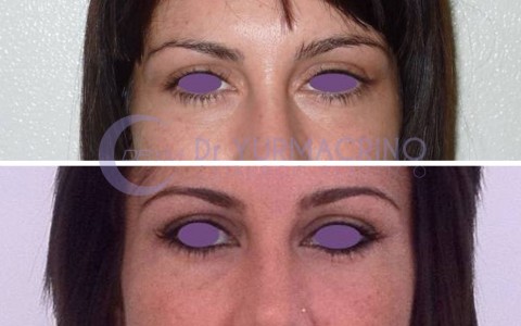 Blepharoplasty – Case 6/A