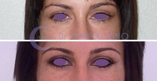 Blepharoplasty – Case 6/A