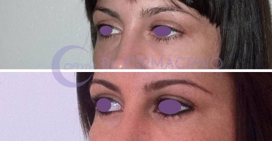 Blepharoplasty – Case 6/B