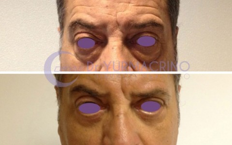 Blepharoplasty – Case 7/A