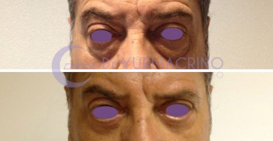 Blepharoplasty – Case 7/A