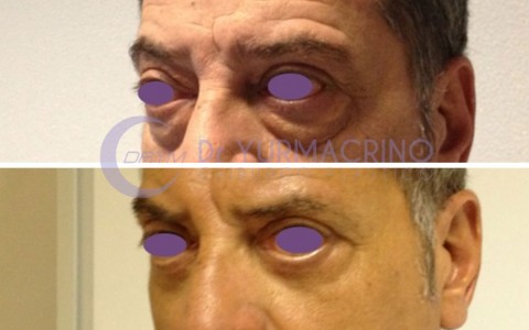 Blepharoplasty – Case 7/B