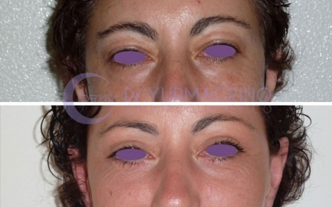 Blepharoplasty – Case 8/A