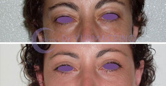 Blepharoplasty – Case 8/A