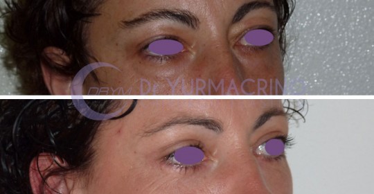 Blepharoplasty – Case 8/B