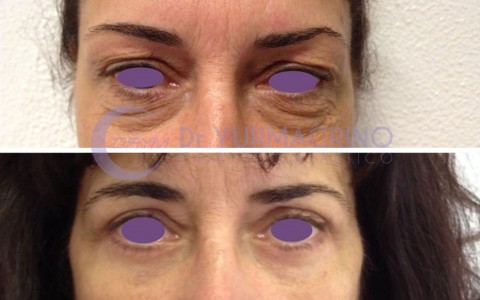 Blepharoplasty – Case 9/A