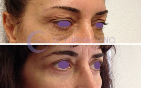 Blepharoplasty – Case 9/B