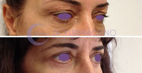 Blepharoplasty – Case 9/B