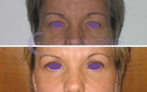 Blepharoplasty – Case 10/A