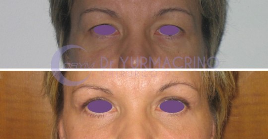 Blepharoplasty – Case 10/A