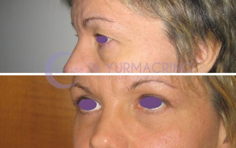 Blepharoplasty – Case 10/B